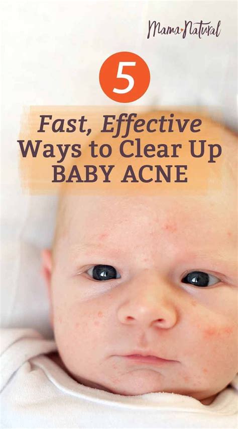 medicine for baby acne